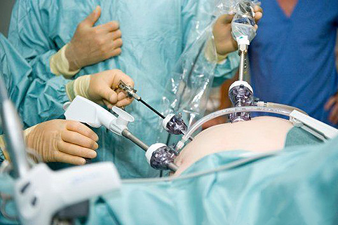Осложнения при лапароскопии в гинекологии