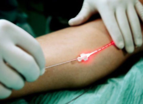 Лазерные технологии в лечении варикозного расширения вен