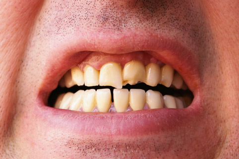 Сколотый или выбитый зуб
