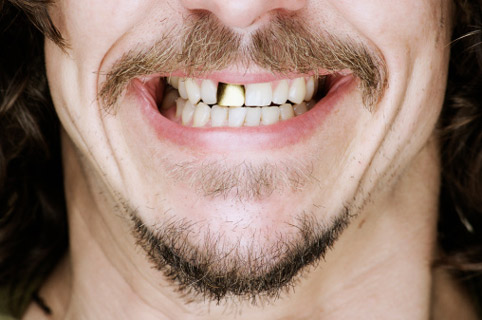 Клиновидная угроза для зубов